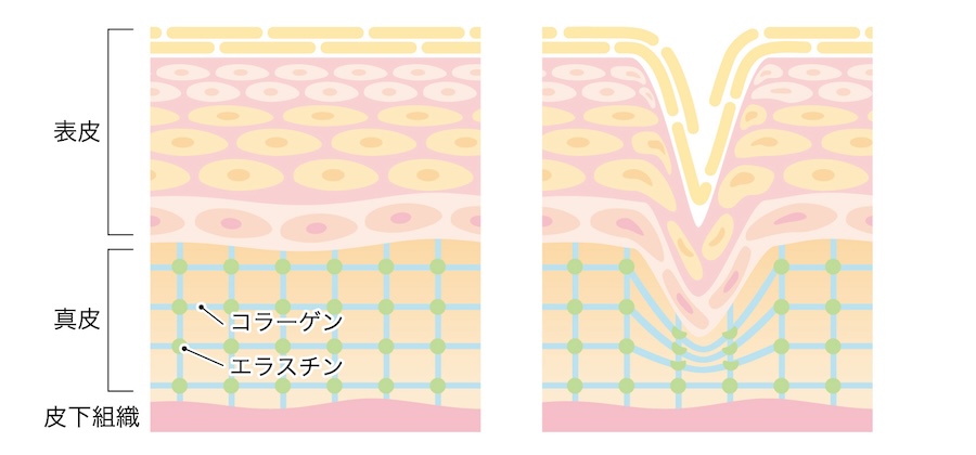 美肌 皮膚ケア 深層 コラーゲン イラスト 図解