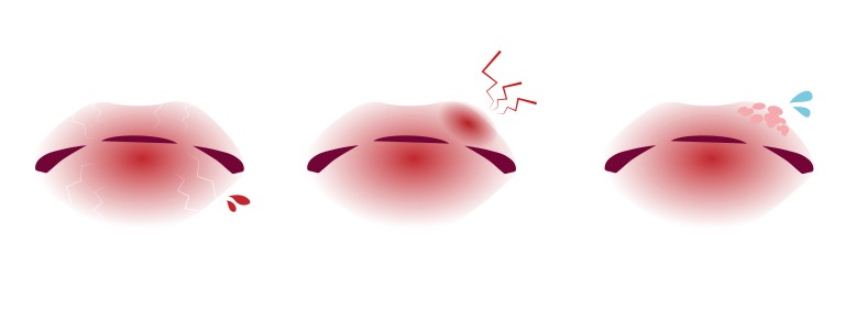 口唇ヘルペスと唇のトラブルのイラスト　リップケア